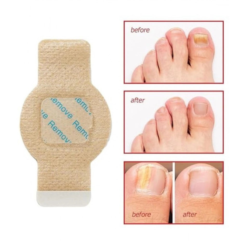 Fungal Nail Patches (Yellow)