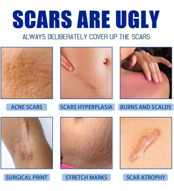 Generic Plastic Scar Removal Cream (White-Blue)