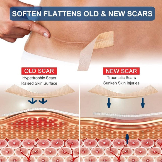 Generic Silicone Scar Tape (Beige)